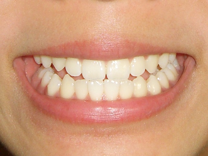 混合歯列期に始める矯正治療
