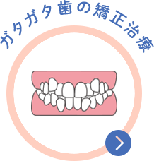 阿波座・本町のタニ矯正歯科で行うガタガタの歯の矯正治療